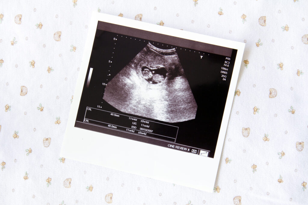 ultrasound image for pregnancy